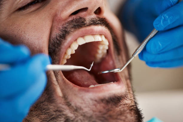 Best Emergency Dentist for Lost Fillings or Crowns in Northwest Harwinton, CT